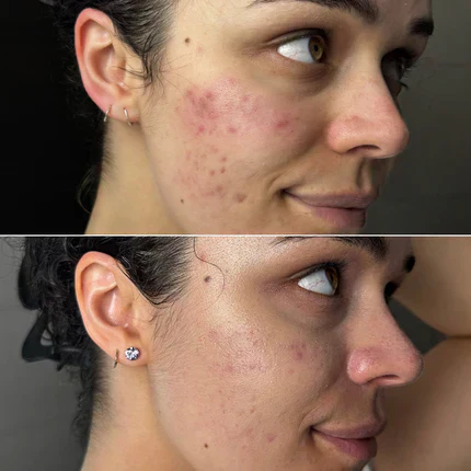 Microneedling + LED Therapy