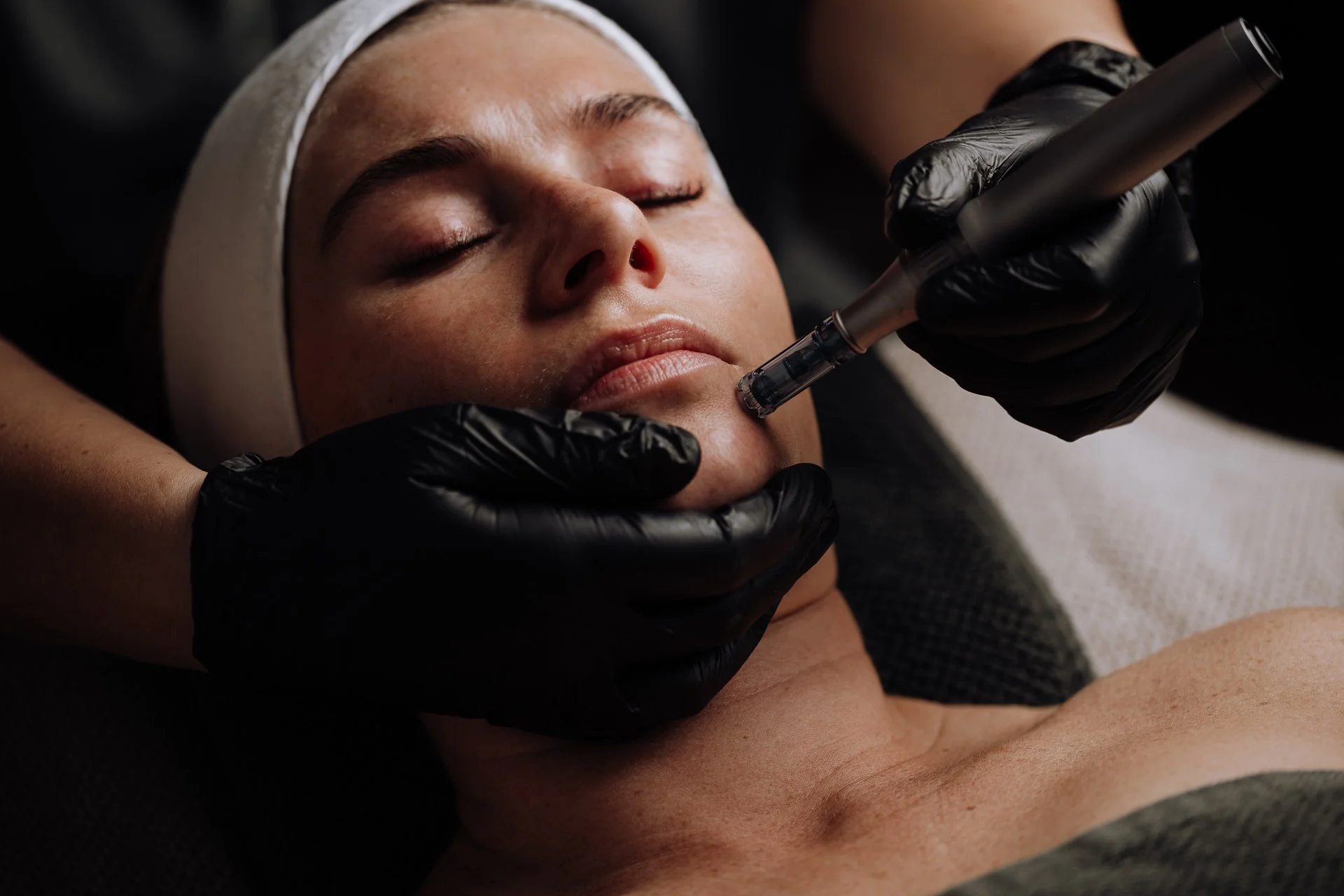 What Is Microneedling?