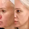 Microneedling with BioRePeel